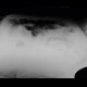 Ileus, bowel ischemia: X-ray - Plain radiograph